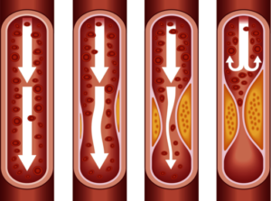 arterie,placche,aterosclerosi,arteriosclerosi,colesterolo,ldl, trombosi, sindrome metabolica, nutrizione, dieta, alimentazione, nutrizionista napoli, soccavo,nutrizionista, vomero